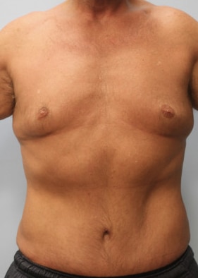 After Image: Abdominoplasty & Lipo- Dr. Howell - front