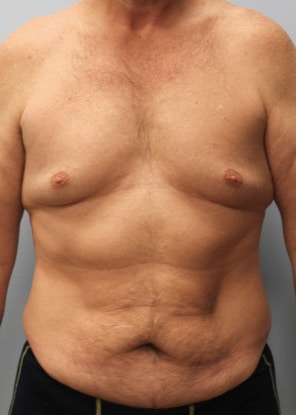 Before Image: Abdominoplasty & Lipo- Dr. Howell - front