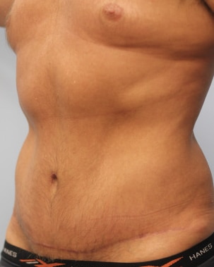 After Image: Abdominoplasty & Lipo- Dr. Howell - left-front-oblique