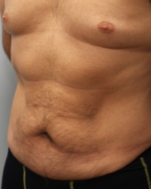 Before Image: Abdominoplasty & Lipo- Dr. Howell - left-front-oblique
