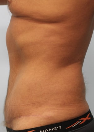 After Image: Abdominoplasty & Lipo- Dr. Howell - left-side