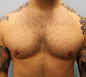 After Image: Gynecomastia- Dr. Howell - front