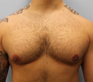 Before Image: Gynecomastia- Dr. Howell - front