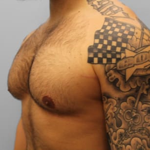 After Image: Gynecomastia- Dr. Howell - left-front-oblique
