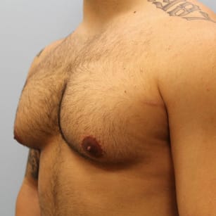 Before Image: Gynecomastia- Dr. Howell - left-front-oblique
