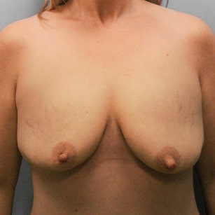 Before Image: Breast Augmentation & Lift- Dr. Howell - front