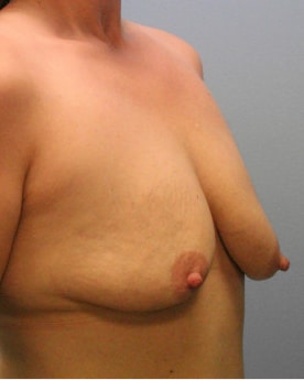 Before Image: Breast Augmentation & Lift- Dr. Howell - right-front-oblique