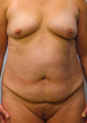 Before Image: Mommy Makeover – Dr. Tucker - front