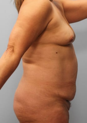 Before Image: Mommy Makeover – Dr. Tucker - right-side