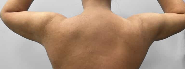 After Image: Liposuction – Dr. Howell - back