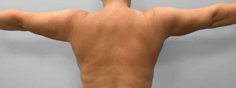 After Image: Liposuction – Dr. Howell - back