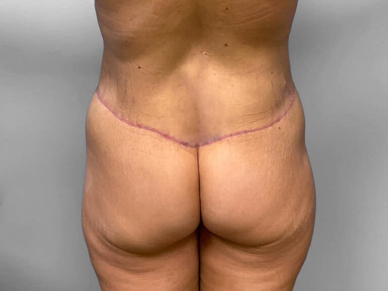After Image: Body Lift – Dr. Howell - back