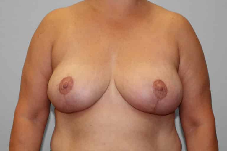After Image: Breast Reduction – Dr. Howell - front
