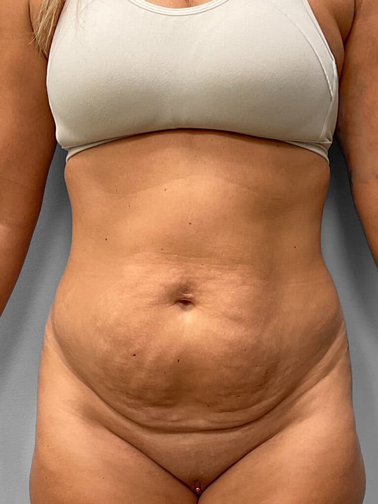 Before Image: Tummy Tuck & Liposuction- Dr. Tucker - front