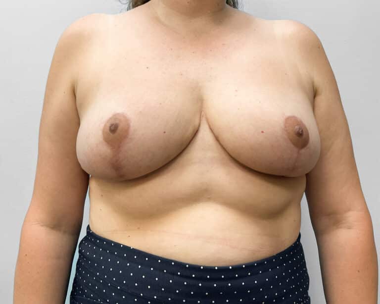 After Image: Breast Reduction- Dr. Howell - front