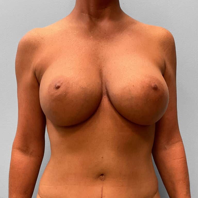 After Image: Mommy Makeover – Dr. Tucker - front