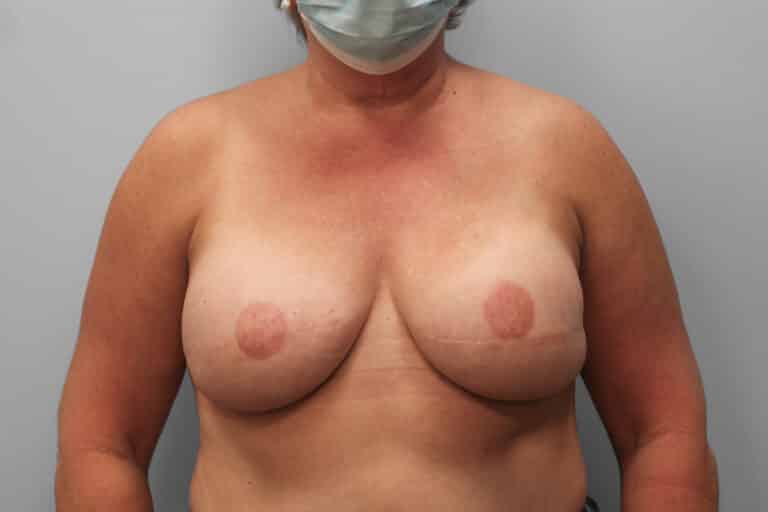 After Image: Breast Reconstruction – Dr. Tucker - front