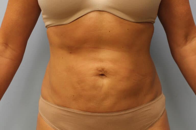 After Image: Smart Lipo – Dr. Tucker - front