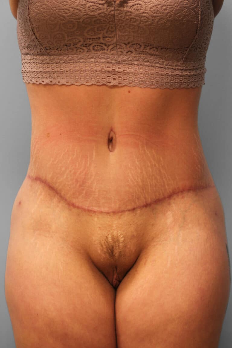After Image: Abdominoplasty – Dr. Howell - front