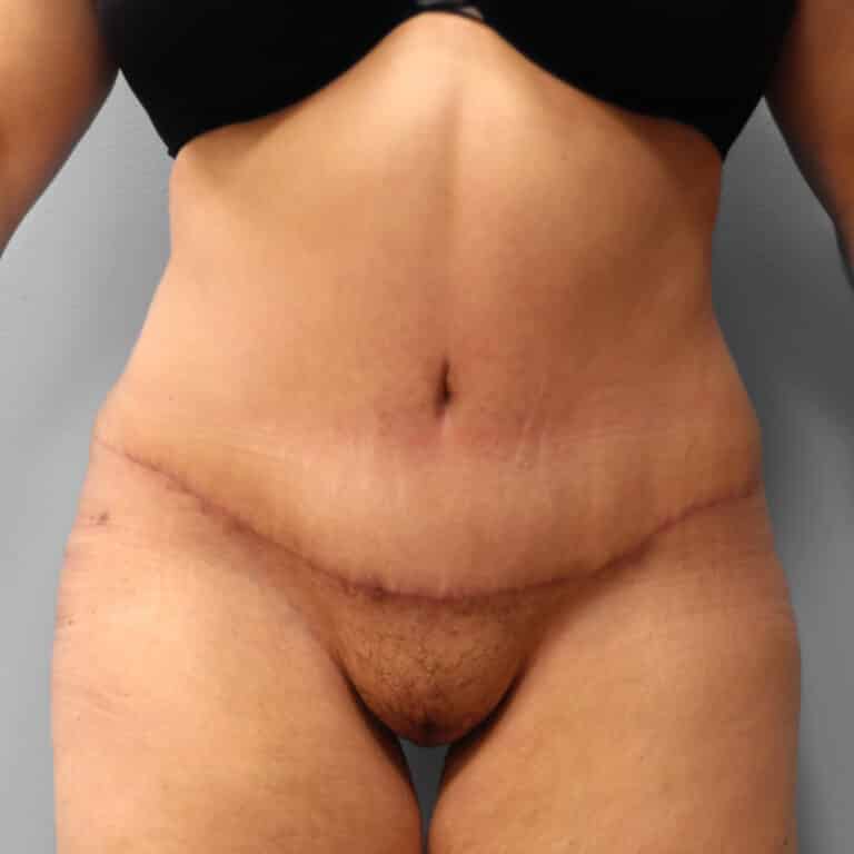 After Image: Abdominoplasty & Lipo – Dr. Howell - front