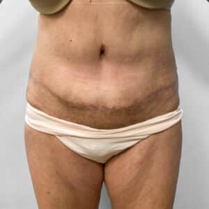 After Image: Abdominoplasty – Dr. Howell
