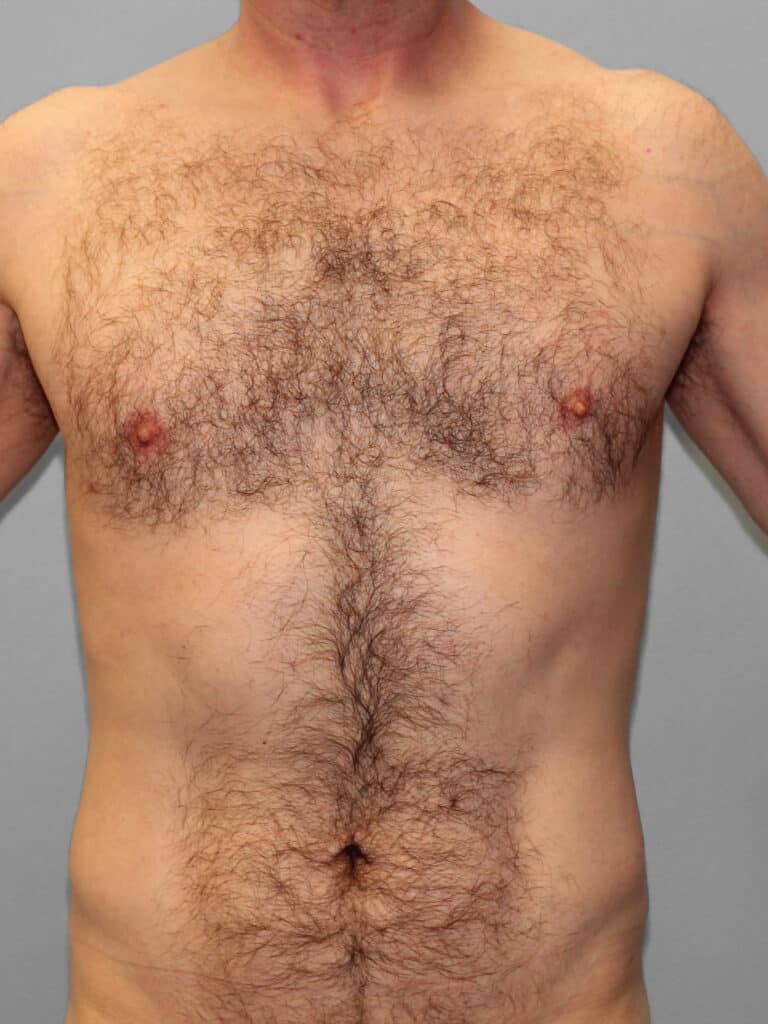 After Image: Gynecomastia & Lipo-Dr. Howell - front