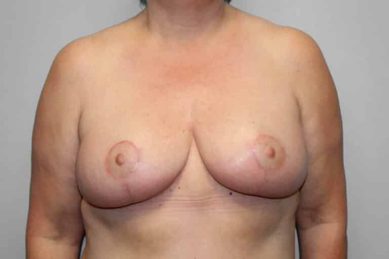 After Image: Breast Reduction, Tummy Tuck & Lipo- Dr.Howell - front