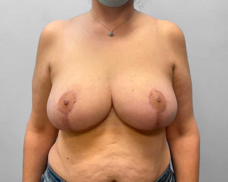 After Image: Breast Reduction – Dr. Howell - front