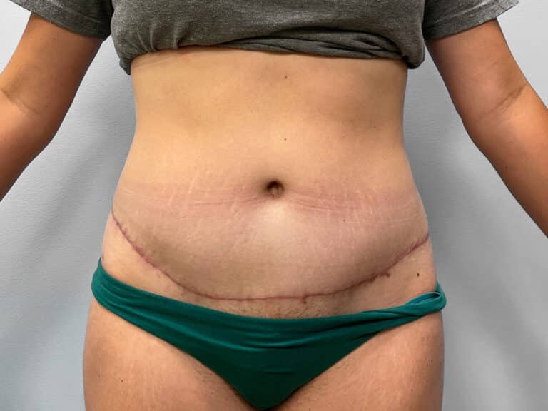 After Image: Abdominoplasty & Liposuction – Dr. Howell - front