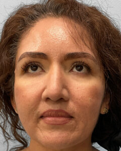 After Image: Rhinoplasty – Dr. Tucker