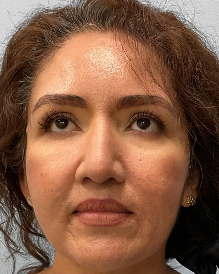 After Image: Rhinoplasty – Dr. Tucker - front