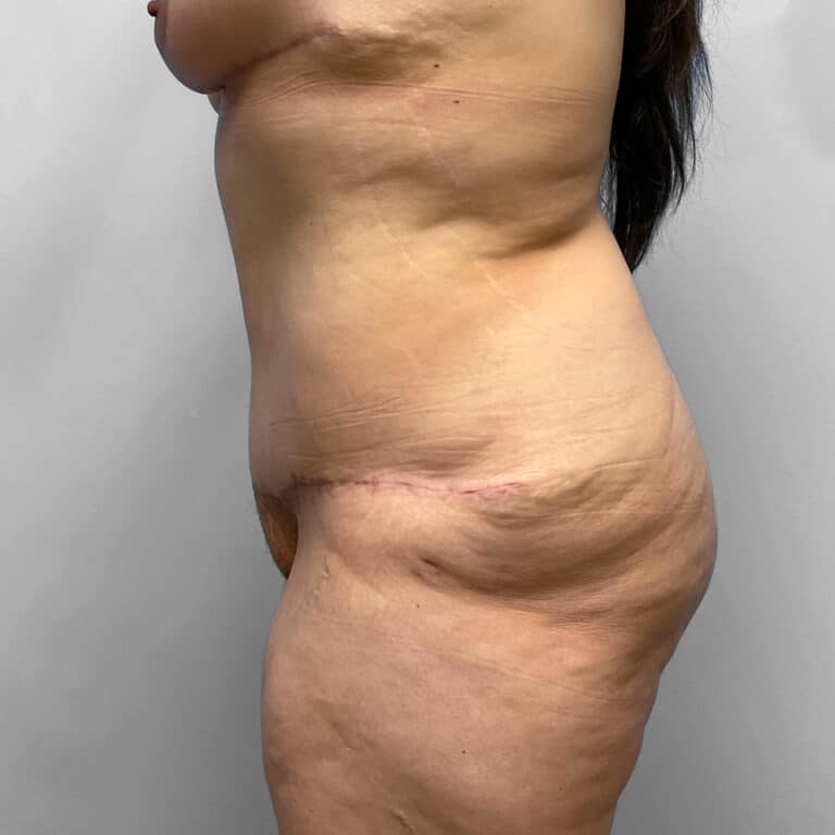 After Image: Tummy Tuck – Dr. Howell - front