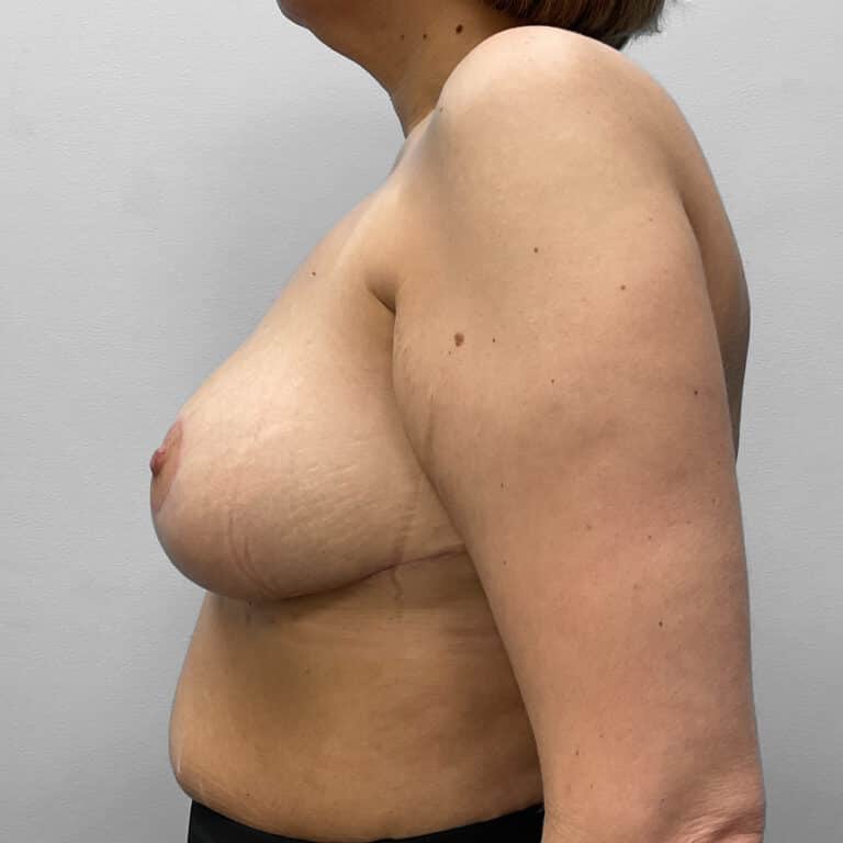 After Image: Breast Reduction- Dr. Howell - left-side