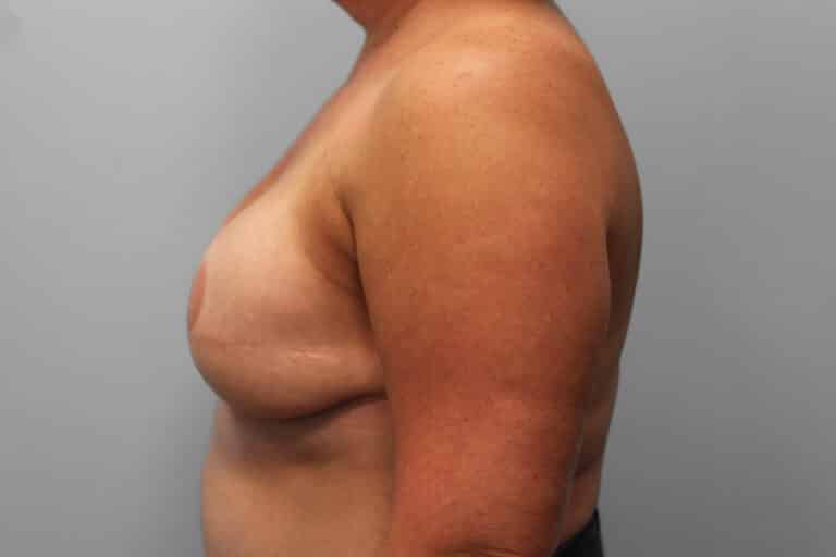 After Image: Breast Reconstruction – Dr. Tucker - left-side