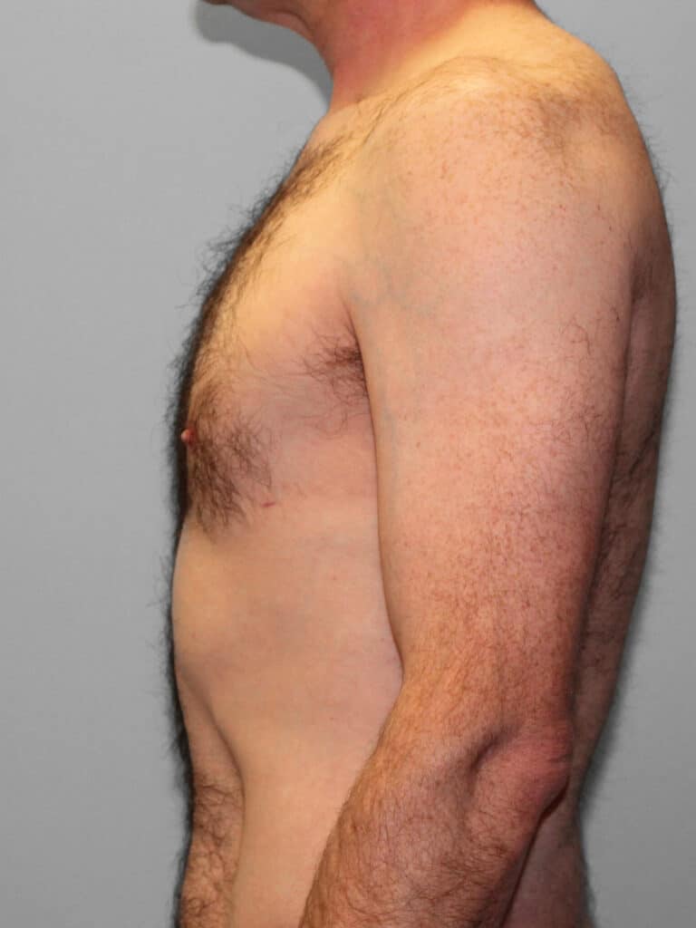 After Image: Gynecomastia & Lipo-Dr. Howell - left-side