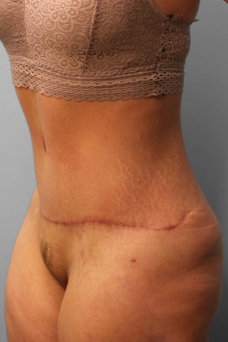 After Image: Abdominoplasty – Dr. Howell - left-side