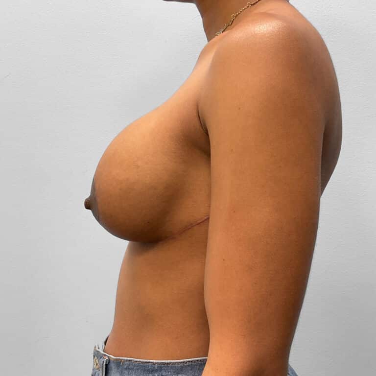 After Image: Breast Implant Revision- Dr. Howell - left-side