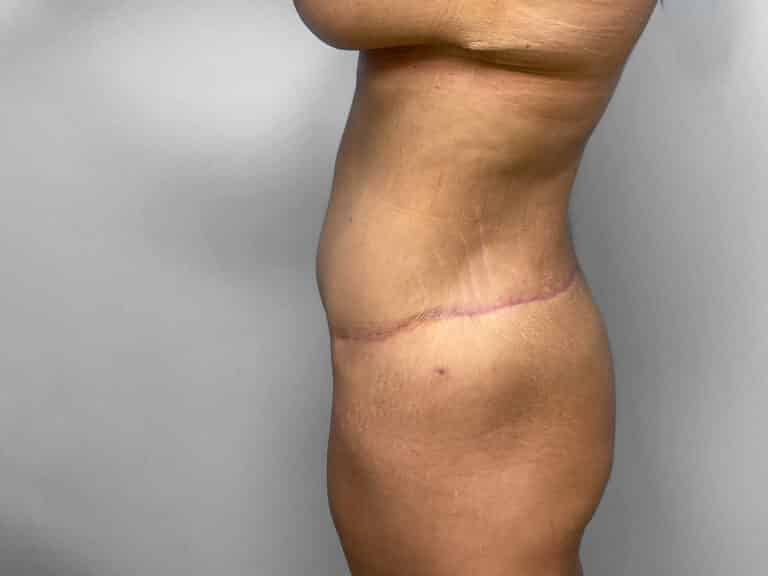 After Image: Body Lift – Dr. Howell - left-side