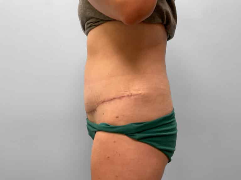 After Image: Abdominoplasty & Liposuction – Dr. Howell - left-side