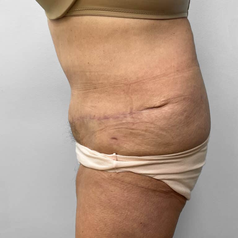 After Image: Abdominoplasty – Dr. Howell - left-side