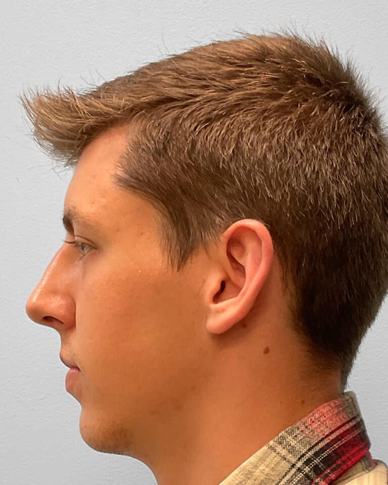 After Image: Rhinoplasty – Dr. Tucker - left-side