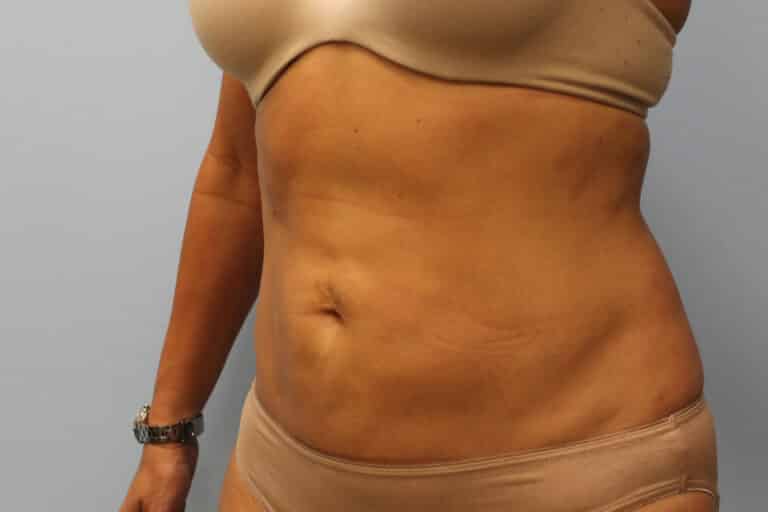 After Image: Smart Lipo – Dr. Tucker - left-front-oblique
