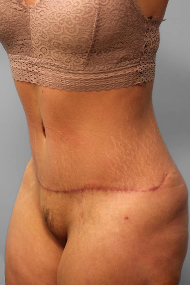 After Image: Abdominoplasty – Dr. Howell - left-front-oblique