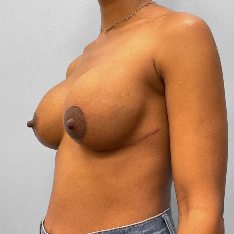 After Image: Breast Implant Revision- Dr. Howell - left-front-oblique