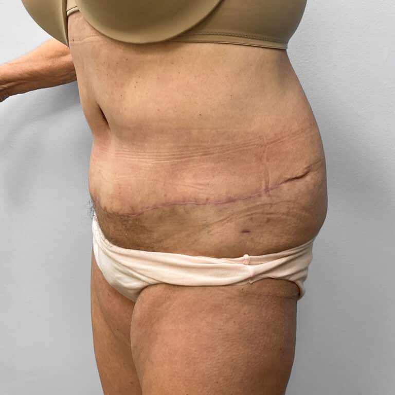 After Image: Abdominoplasty – Dr. Howell - left-front-oblique