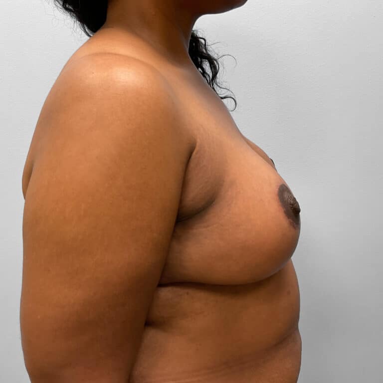 After Image: Breast & Arm Lift with Liposuction – Dr. Howell - right-side