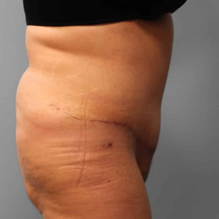 After Image: Abdominoplasty & Lipo – Dr. Howell - right-side