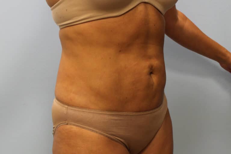 After Image: Smart Lipo – Dr. Tucker - right-front-oblique