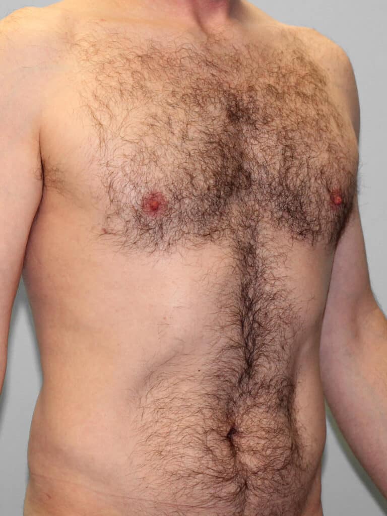 After Image: Gynecomastia & Lipo-Dr. Howell - right-front-oblique
