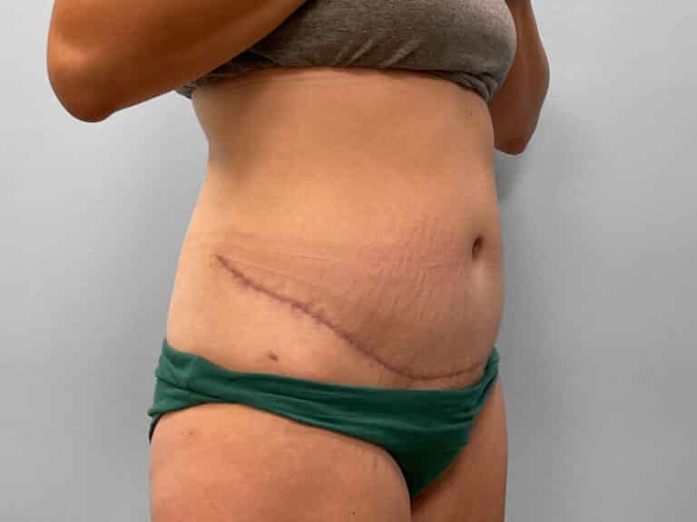 After Image: Abdominoplasty & Liposuction – Dr. Howell - right-front-oblique